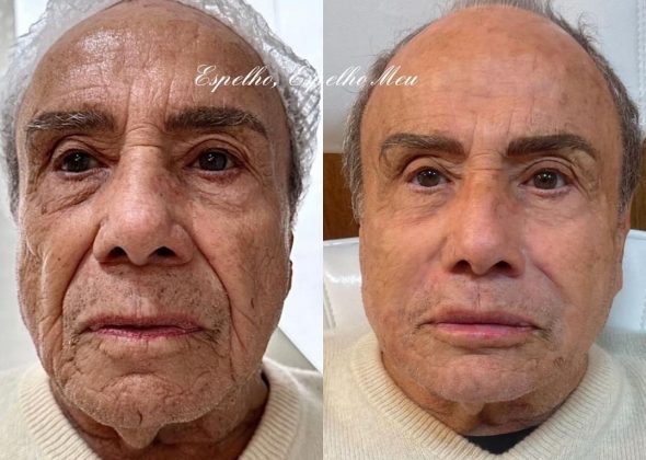 Stenio Garcia surpreendeu o público com o resultado de sua harmonização facial recente. (Foto Instagram)