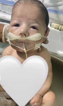 Bebê enfrentou malformações congênitas graves. (Foto: Instagram)
