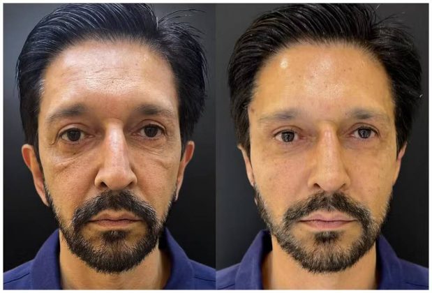Prefeito Nunes nega vantagem indevida por procedimento estético. (Foto: Instagram)