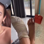 Larissa Santos sofre acidente com box de vidro e leva 14 pontos: "Dava para ver o osso" (Foto: Instagram)