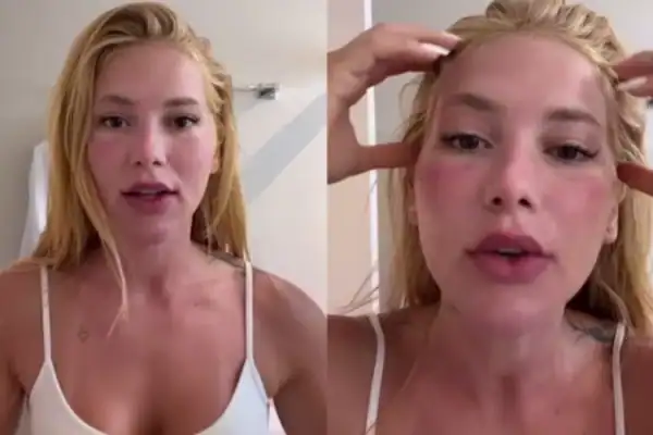 Virginia Fonseca assusta seguidores ao surgir com rosto inchado e se explica