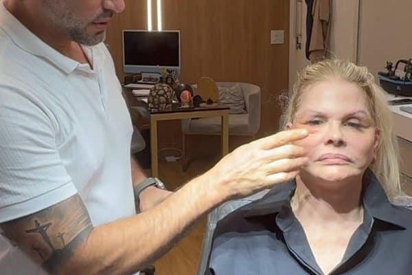 Monique Evans impressiona após revelar pós-operatório de cirurgia facial