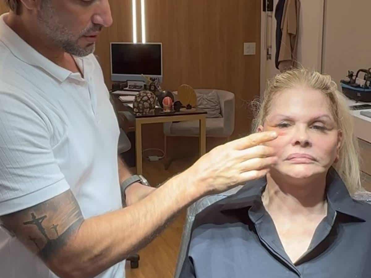 Monique Evans impressiona após revelar pós-operatório de cirurgia facial (Foto: Instagram)
