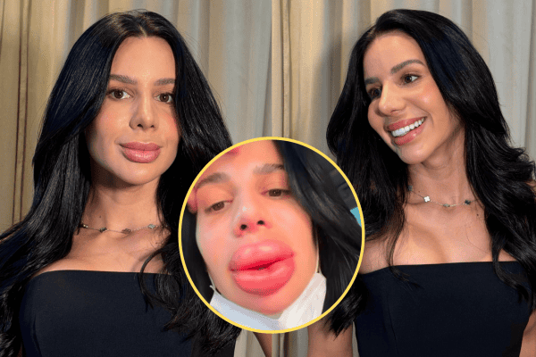 Mulher choca ao mostrar resultado imediato da remoção do preenchimento labial