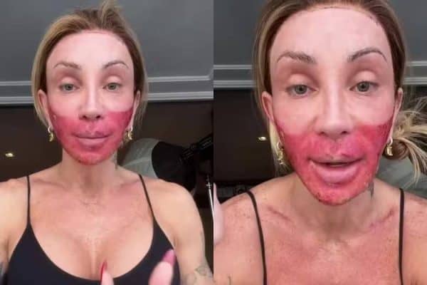 Maya Massafera surge com rosto vermelho após peeling e revela: “Hoje, é o pior dia”