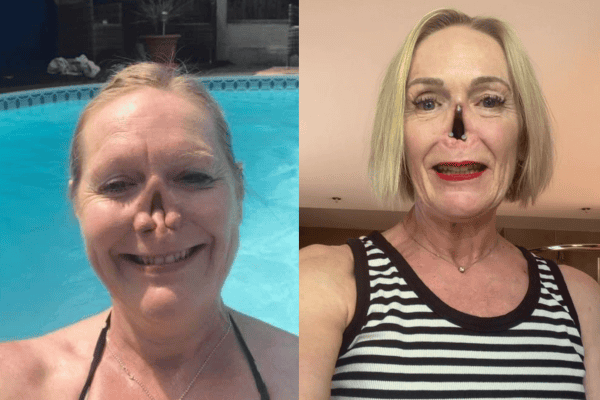 Doença rara fez mulher perder o nariz; veja como ela vive hoje
