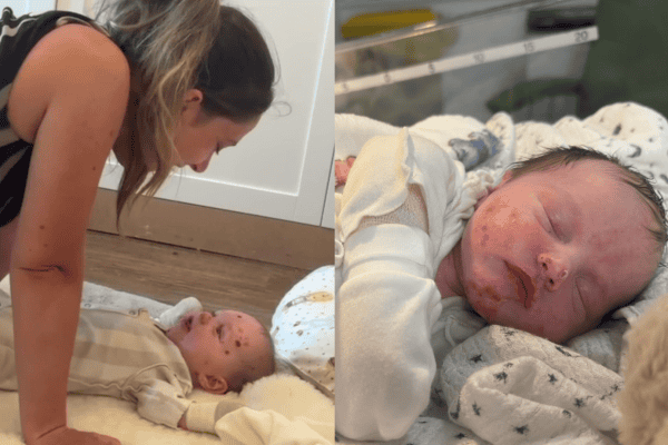 Bebê com doença rara tem pele tão frágil que mãe não consegue segurá-lo
