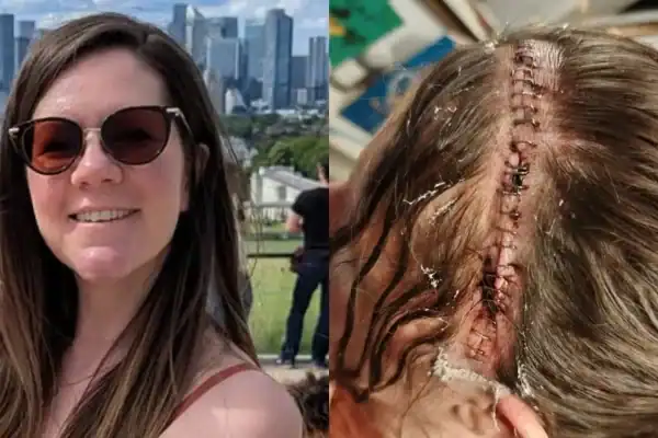 Mulher conviveu por anos com fortes enxaquecas até descobrir o que estava crescendo em seu cérebro