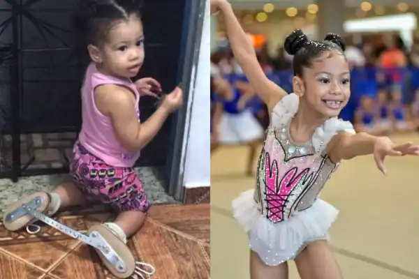 Menina que nasceu com pé torto congênito supera tratamento e realiza sonho de ser ginasta