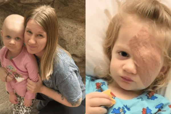 Mãe percebe brilho estranho no olho da filha de 3 anos e descobre câncer que levou à retirada do órgão