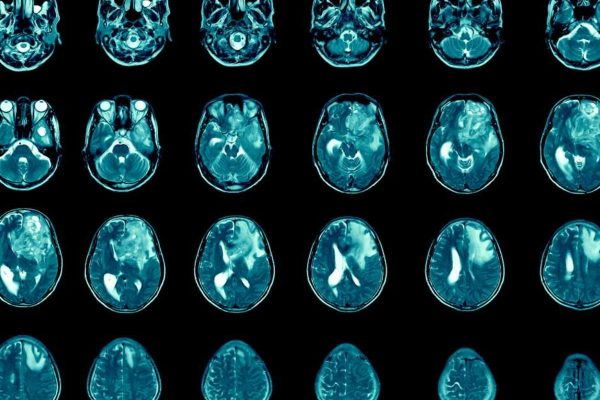Melatonina: aliada inesperada na luta contra o glioblastoma, o câncer cerebral mais agressivo